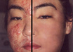 professionally rid your face of acne in up to two images