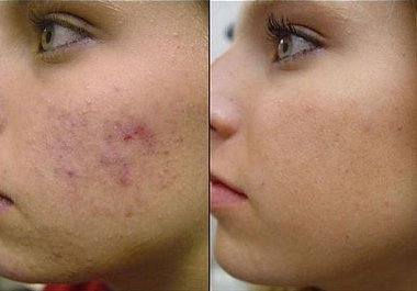 digitally remove blemishes, bumps, redness, and other flaws from your face big1