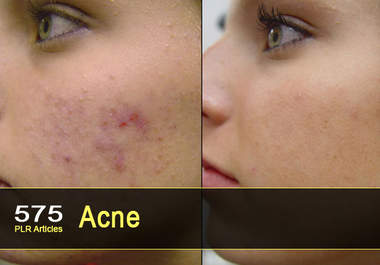 give you 575 PLR Articles on Acne big1